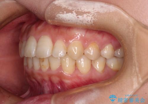 前歯のクロスバイト 目立たないワイヤー装置で速やかに矯正治療の治療後