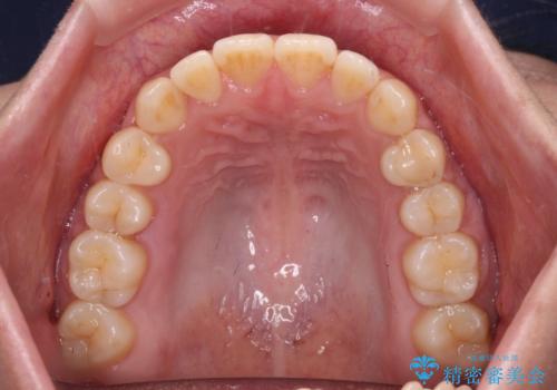 前歯のクロスバイト 目立たないワイヤー装置で速やかに矯正治療の治療後