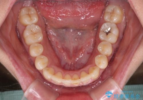 前歯のクロスバイト　目立たないワイヤー装置で速やかに矯正治療の治療後