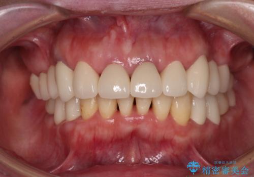 銀歯や入れ歯で汚い歯をきれいにしたい 総合歯科治療の治療後