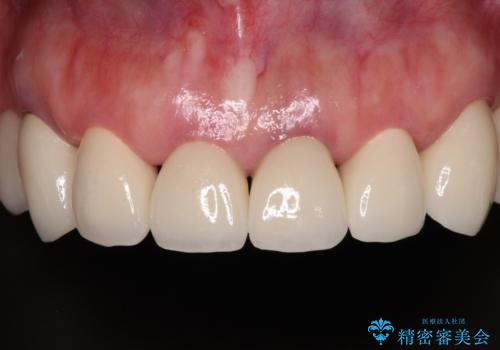 銀歯や入れ歯で汚い歯をきれいにしたい 総合歯科治療の症例 治療後