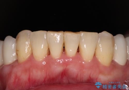 銀歯や入れ歯で汚い歯をきれいにしたい 総合歯科治療の治療後