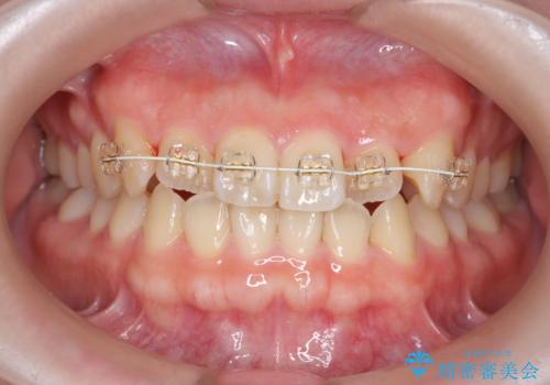 前歯のねじれを改善 小矯正+マウスピース矯正インビザラインの治療中