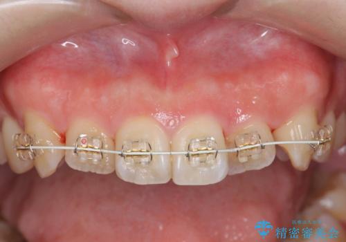 前歯のねじれを改善 小矯正+マウスピース矯正インビザラインの治療中