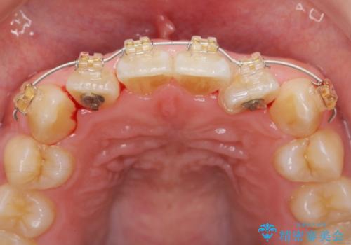 前歯のねじれを改善　小矯正+マウスピース矯正インビザラインの治療中