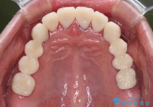 銀歯や入れ歯で汚い歯をきれいにしたい 総合歯科治療の治療後