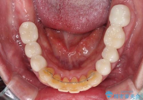 銀歯や入れ歯で汚い歯をきれいにしたい 総合歯科治療の治療後