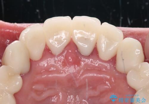 銀歯や入れ歯で汚い歯をきれいにしたい 総合歯科治療の治療後