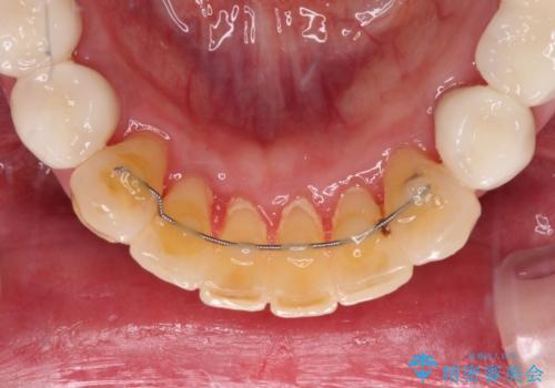 銀歯や入れ歯で汚い歯をきれいにしたい　総合歯科治療の治療後