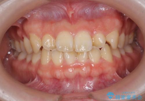 前歯のねじれを改善　小矯正+マウスピース矯正インビザラインの症例 治療前