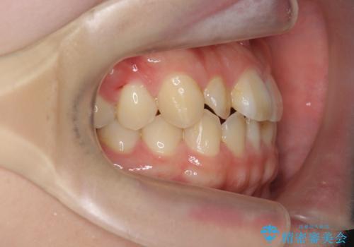 前歯のねじれを改善 小矯正+マウスピース矯正インビザラインの治療前