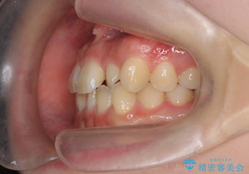 前歯のねじれを改善　小矯正+マウスピース矯正インビザラインの治療前