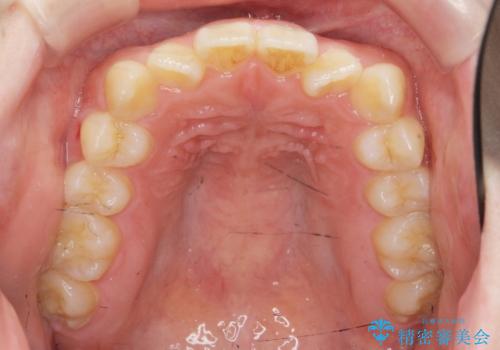 前歯のねじれを治したい (部分矯正を併用したマウスピース矯正)の治療前