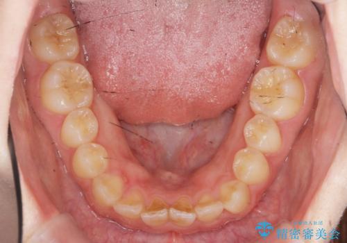 前歯のねじれを治したい (部分矯正を併用したマウスピース矯正)の治療前