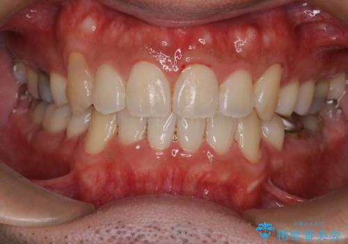 飛び出た八重歯!コンプレックスを払拭!の治療後