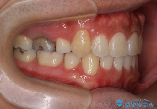 飛び出た八重歯!コンプレックスを払拭!の治療後
