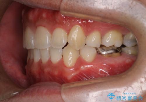 飛び出た八重歯!コンプレックスを払拭!の治療後