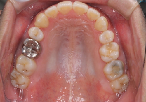 飛び出た八重歯!コンプレックスを払拭!の治療後