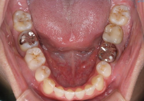 飛び出た八重歯!コンプレックスを払拭!の治療後