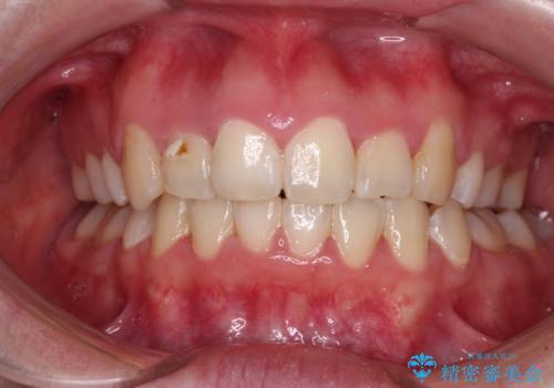 骨格的なズレをカムフラージュ　抜歯矯正で咬み合わせを改善の症例 治療後