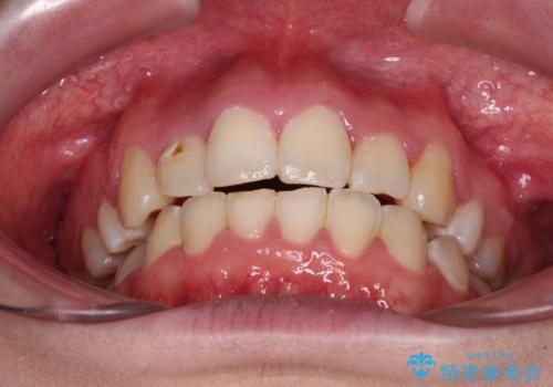 骨格的なズレをカムフラージュ 抜歯矯正で咬み合わせを改善の治療後