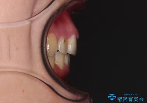 骨格的なズレをカムフラージュ　抜歯矯正で咬み合わせを改善の治療後
