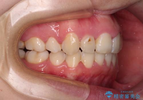 骨格的なズレをカムフラージュ 抜歯矯正で咬み合わせを改善の治療後
