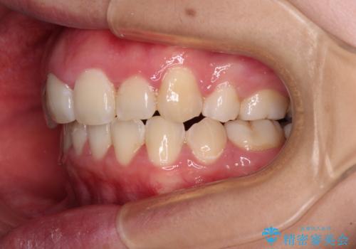 骨格的なズレをカムフラージュ　抜歯矯正で咬み合わせを改善の治療後