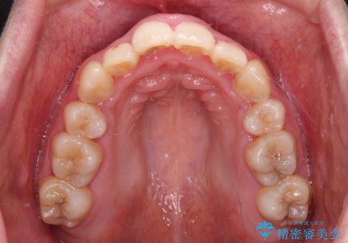 骨格的なズレをカムフラージュ 抜歯矯正で咬み合わせを改善の治療後