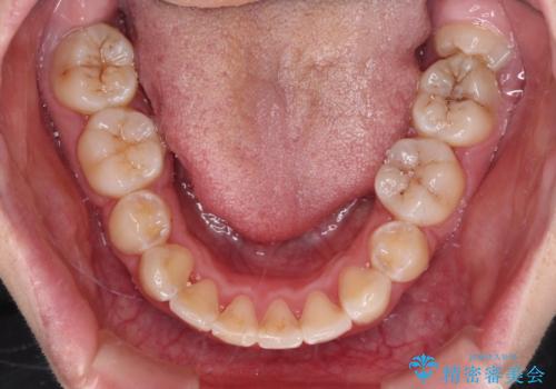 骨格的なズレをカムフラージュ 抜歯矯正で咬み合わせを改善の治療後