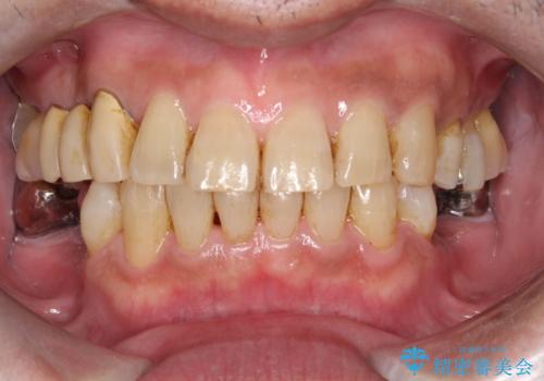 着色が目立ってきたためエアーフローでクリーニングの症例 治療前