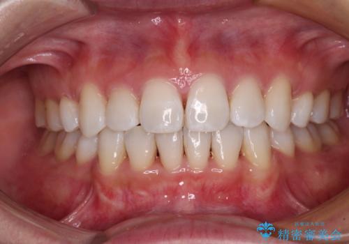 出っ歯を改善　目立たないワイヤー装置での抜歯矯正の治療後