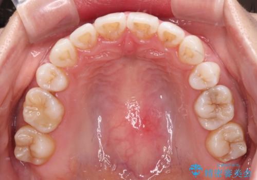 出っ歯を改善　目立たないワイヤー装置での抜歯矯正の治療後