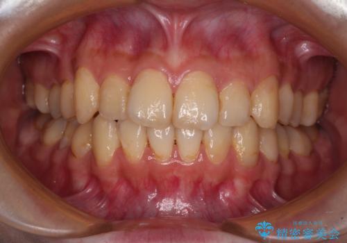 デコボコ歯列をきれいに インビザラインによる矯正治療の症例 治療後