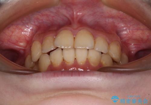 デコボコ歯列をきれいに　インビザラインによる矯正治療の治療後