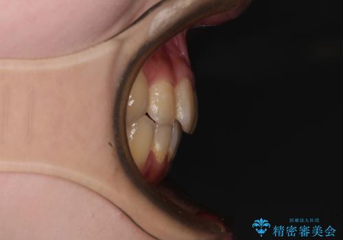 デコボコ歯列をきれいに インビザラインによる矯正治療の治療後