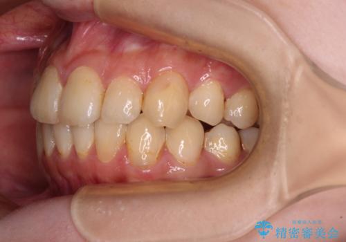 デコボコ歯列をきれいに インビザラインによる矯正治療の治療後