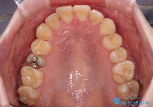 デコボコ歯列をきれいに インビザラインによる矯正治療の治療後