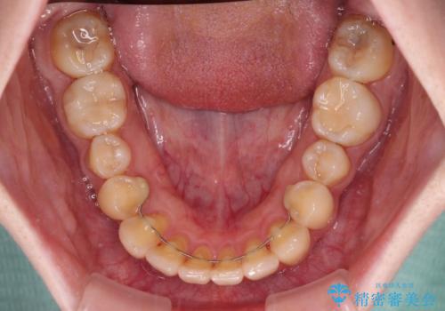 デコボコ歯列をきれいに インビザラインによる矯正治療の治療後