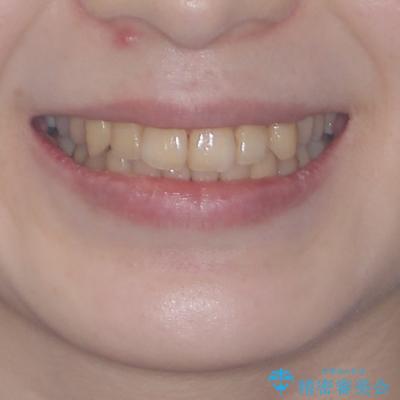 デコボコ歯列をきれいに インビザラインによる矯正治療の治療後(顔貌)