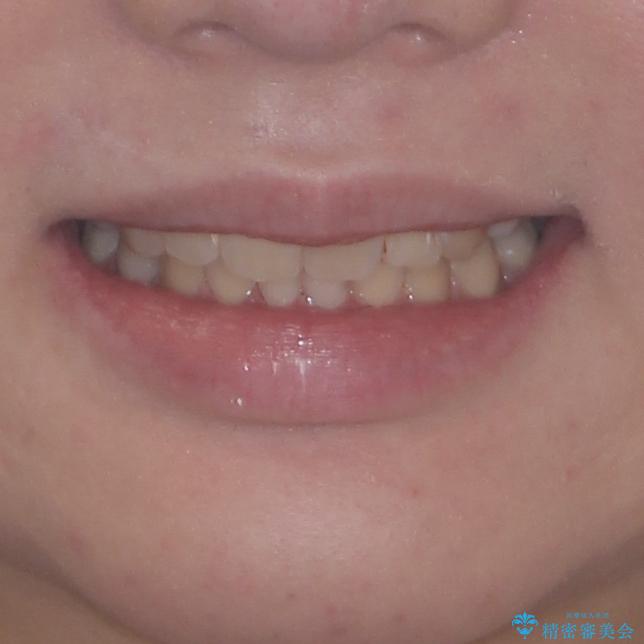 著しい八重歯を短期間で改善　ワイヤー装置による抜歯矯正の治療後（顔貌）