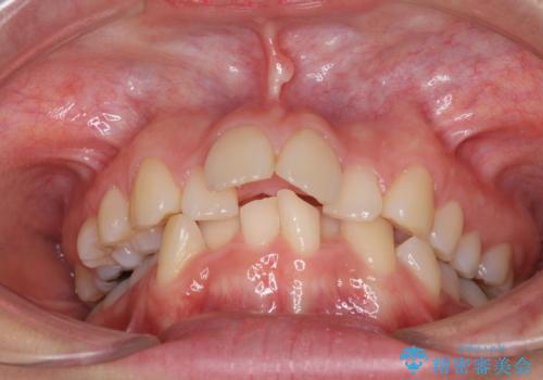 デコボコで飛び出した前歯 ワイヤー装置による抜歯矯正の治療前