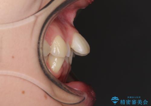 デコボコで飛び出した前歯 ワイヤー装置による抜歯矯正の治療前