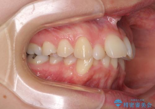 デコボコで飛び出した前歯　ワイヤー装置による抜歯矯正の治療前