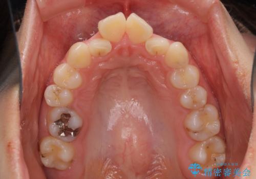 デコボコで飛び出した前歯 ワイヤー装置による抜歯矯正の治療前