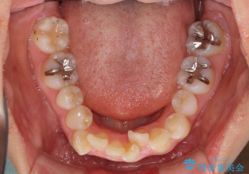 デコボコで飛び出した前歯　ワイヤー装置による抜歯矯正の治療前