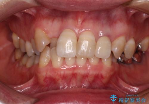 変色した前歯をオールセラミッククラウンで自然な口元にの治療後
