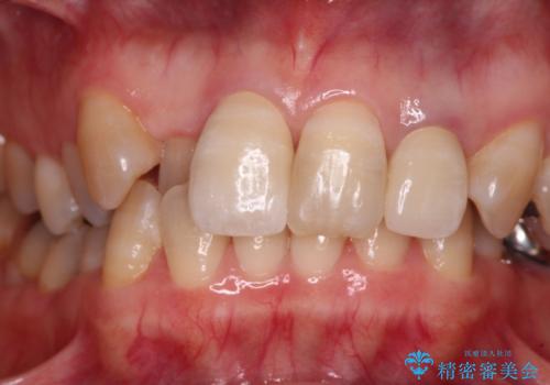 変色した前歯をオールセラミッククラウンで自然な口元にの治療後