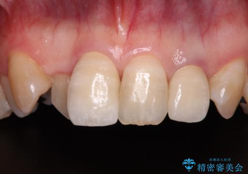 変色した前歯をオールセラミッククラウンで自然な口元にの症例 治療後