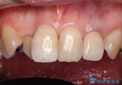 変色した前歯をオールセラミッククラウンで自然な口元にの治療後